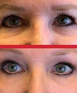 Eyeliner Tattoo result by Beautiful You Med Spa in Springfield, MO