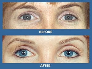 Eyeliner Tattoo result by Best Permanent Makeup by Jeffery Lyle Segal in New York, NY