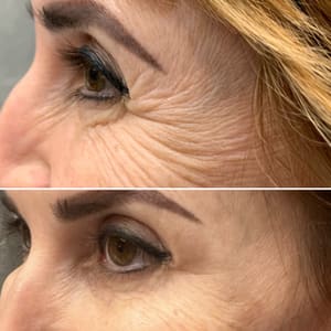 Eyeliner Tattoo result by Blue Iris Medical Aesthetics in Parkland, FL