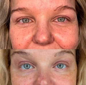 Eyeliner Tattoo result by Fibroplasmabeauty in Playa Del Rey, CA