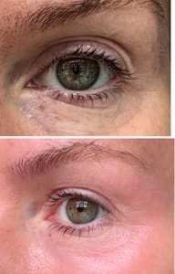 Eyeliner Tattoo result by Fibroplasmabeauty in Playa Del Rey, CA