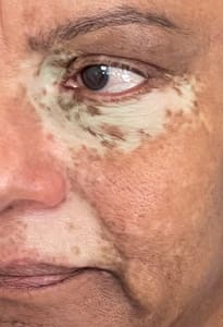 Eyeliner Tattoo result by Mirinka Permanent Cosmetic Centers. Specialist in Cosmetic Tattooing and ParaMedical Tattooing in Fort Lauderdale, FL