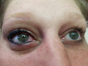Eyeliner Tattoo result by Natural Illusions 3 locations Cumberland MD, Fairmont AND Weirton WV MAIN LOCATION FAIRMONT WV in Fairmont, WV