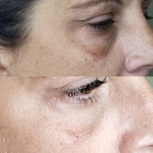 Eyeliner Tattoo result by New Ro Aesthetics in New Rochelle, NY