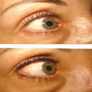 Eyeliner Tattoo result by Rosie Wells Permanent Cosmetics and Microblading at Illume Cosmetic Surgery and MedSpa in Glendale, WI