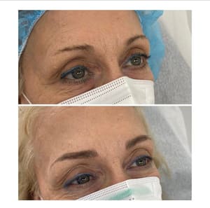 Eyeliner Tattoo result by Skinlab Medspa Jupiter in Jupiter, FL