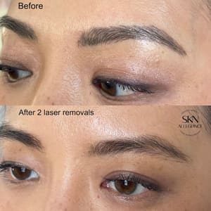Eyeliner Tattoo result by SKN ALLEGIANCE Laser tattoo & Permanent makeup removal in Huntingdon Valley, PA