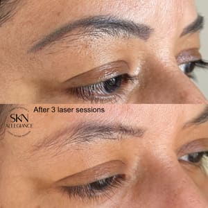 Eyeliner Tattoo result by SKN ALLEGIANCE Laser tattoo & Permanent makeup removal in Huntingdon Valley, PA