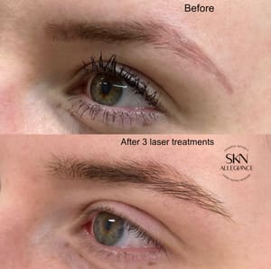 Eyeliner Tattoo result by SKN ALLEGIANCE Laser tattoo & Permanent makeup removal in Huntingdon Valley, PA
