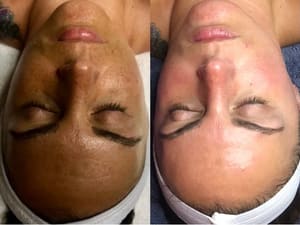 Eyeliner Tattoo result by SPA SUITES by Jem Esthetics LLC in New Haven, CT