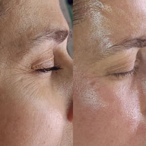 Eyeliner Tattoo result by Tulips Skin Clinic in Herndon, VA