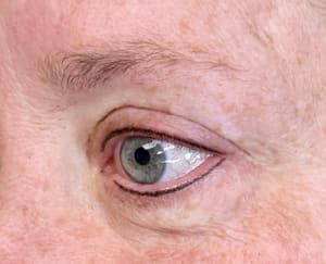 Eyeliner Tattoo result by YDerma Clinica in Apollo Beach, FL