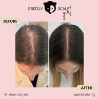Grizzly Scalp - Scalp Micropigmentation - permanent makeup work