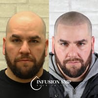 Infusion SMP Scalp Micropigmentation - permanent makeup work