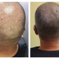 Ink-credible Scalp Micropigmentation - permanent makeup work