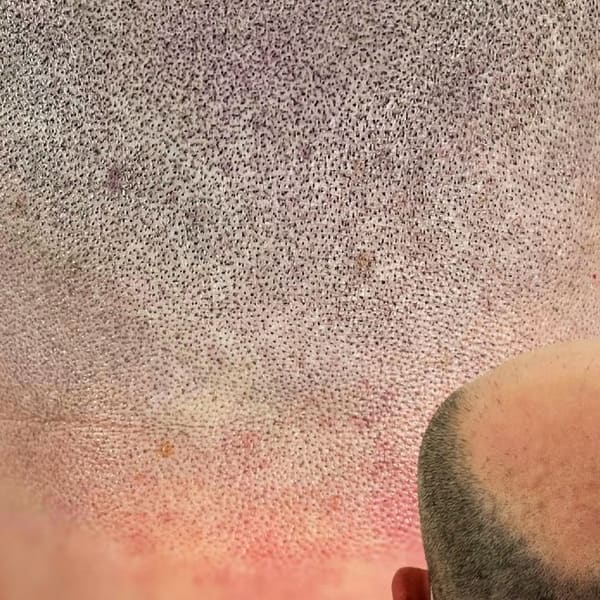 INK HDZ Scalp Micropigmentation - permanent makeup in Santa Monica, CA