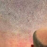 INK HDZ Scalp Micropigmentation - permanent makeup work