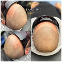 KAL’s SMP & Hair Replacement Clinic - permanent makeup work