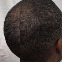 KCole Scalp Micropigmentation (SMP) - permanent makeup work