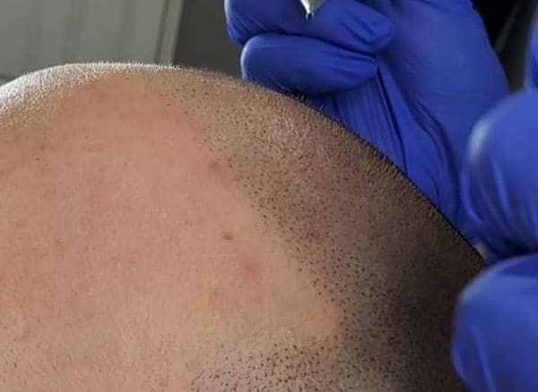 Micro Capillary Solution - permanent makeup in Miami, FL