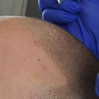 Micro Capillary Solution - permanent makeup work