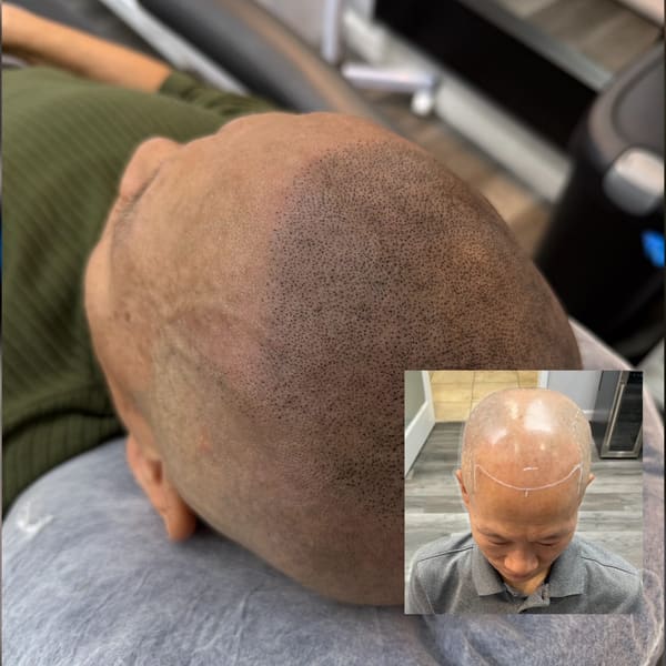 NuHair Ink Scalp Micropigmentation - permanent makeup in Roseville, CA