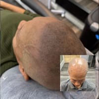 NuHair Ink Scalp Micropigmentation - permanent makeup work