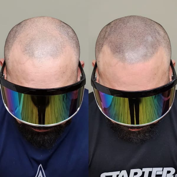 OM SCALP Micropigmentation Hair Tattoo - permanent makeup in Chicago, IL