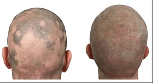 Permanent makeup work by 3D Camouflage AZ in Phoenix, AZ