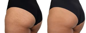 Permanent makeup work by Camouflage Stretch Marks in Ballston Spa, NY