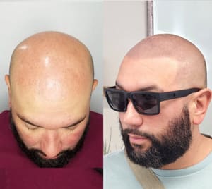 Permanent makeup work by Downey Hair Loss Solutions SMP in Ventura, CA