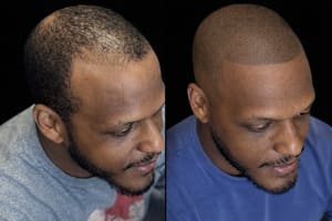 Permanent makeup work by Scalp Micropigmentation By Steven Bradley in Grovetown, GA