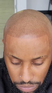 Permanent makeup work by Scalp Micropigmentation - The Art of SMP New York in New Rochelle, NY
