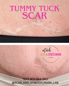 Permanent makeup work by Utah Scar and Stretch Mark Lab in Draper, UT