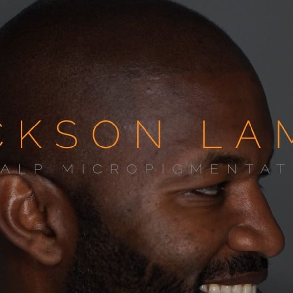 Jackson Lamar Scalp Micropigmentation - scalp micropigmentation in Dallas, TX