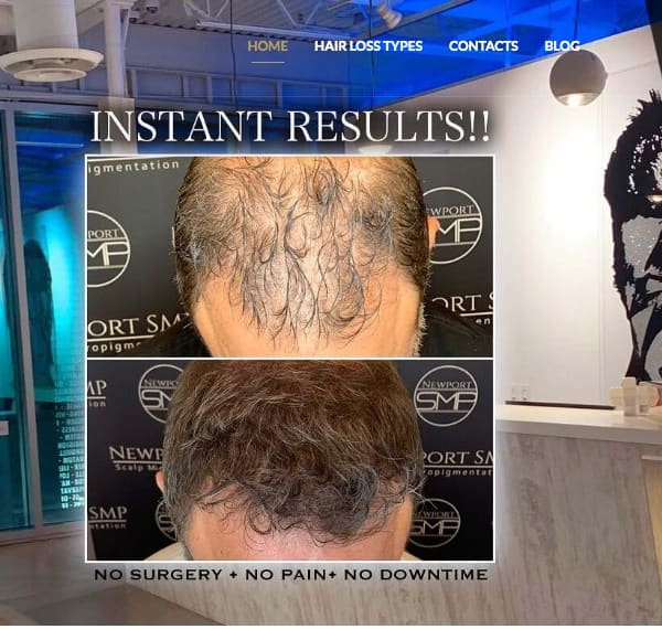 Newport SMP - scalp micropigmentation in Newport Beach, CA
