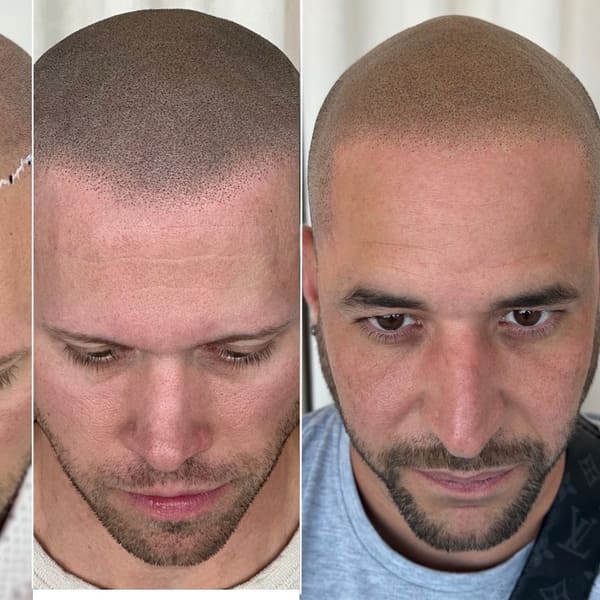 Picasso Scalp Micropigmentation- Chicago - permanent makeup in La Grange Park, IL