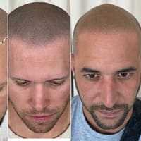 Picasso Scalp Micropigmentation- Chicago - permanent makeup work