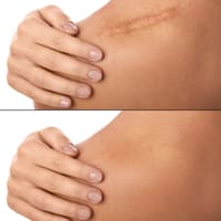 PMU Scar Clinic - permanent makeup work