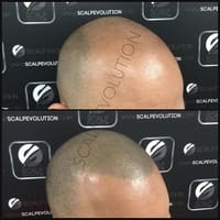 Scalp Evolution - Scalp Micropigmentation Miami SMP - Micropigmentacion Capilar - permanent makeup work