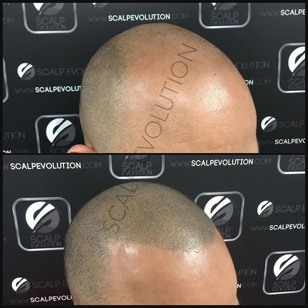 Scalp Evolution - Scalp Micropigmentation Miami SMP - Micropigmentacion Capilar - permanent makeup in Miami, FL