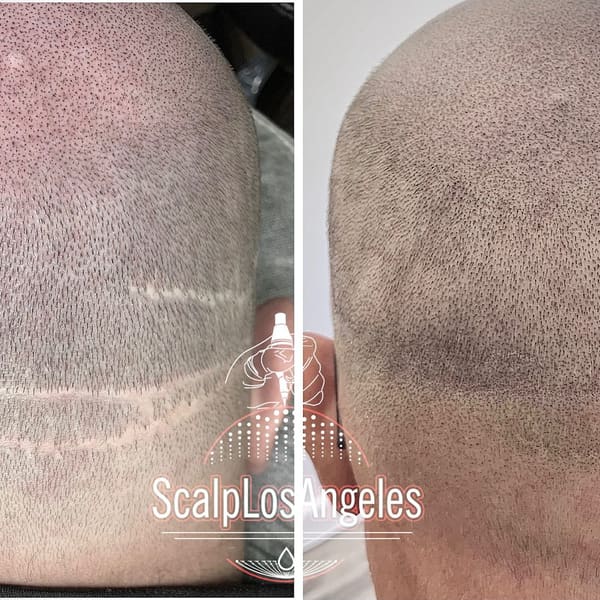 Scalp Los Angeles - Scalp Micropigmentation in Los Angeles - permanent makeup in Sherman Oaks, CA