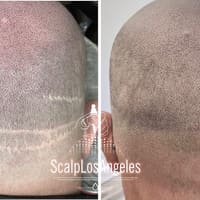 Scalp Los Angeles - Scalp Micropigmentation in Los Angeles - permanent makeup work