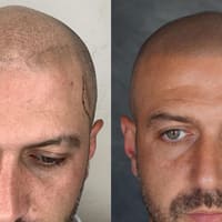 Scalp Micropigmentation Austin Texas - permanent makeup work
