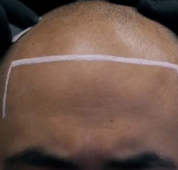 Scalp Micropigmentation by BarberINK - permanent makeup in Bronx, NY