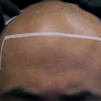 Scalp Micropigmentation by BarberINK - permanent makeup work