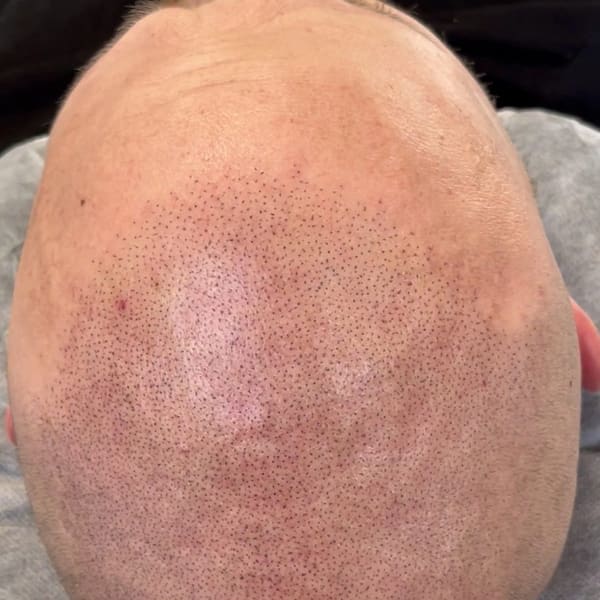 Scalp3D - permanent makeup in Puyallup, WA