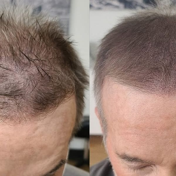 Scalpp Clinic - Scalp Micropigmentation Austin - permanent makeup in Austin, TX