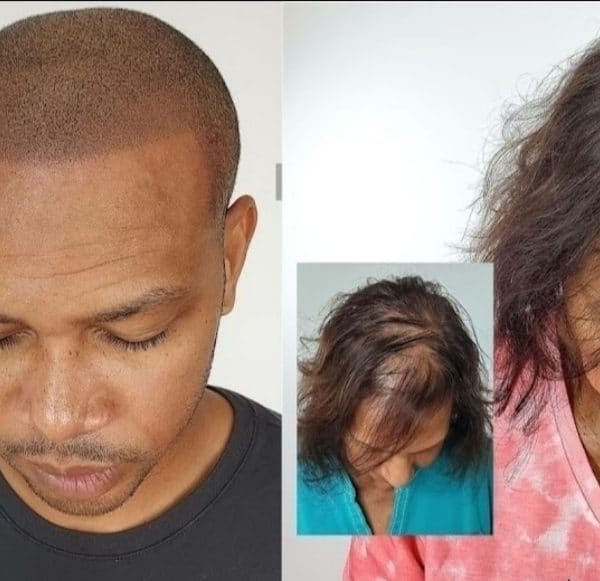 Scalpp Clinic : Scalp Micropigmentation San Antonio (SMP) - permanent makeup in San Antonio, TX