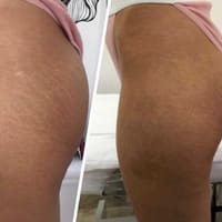 Skinspiration- Stretch Mark & Scar Camouflage Studio - permanent makeup work